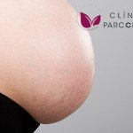 Consejos para evitar las estrías durante el embarazo