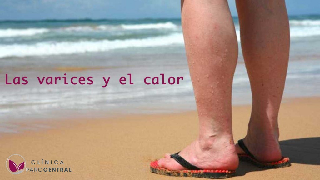 Las varices y el calor
