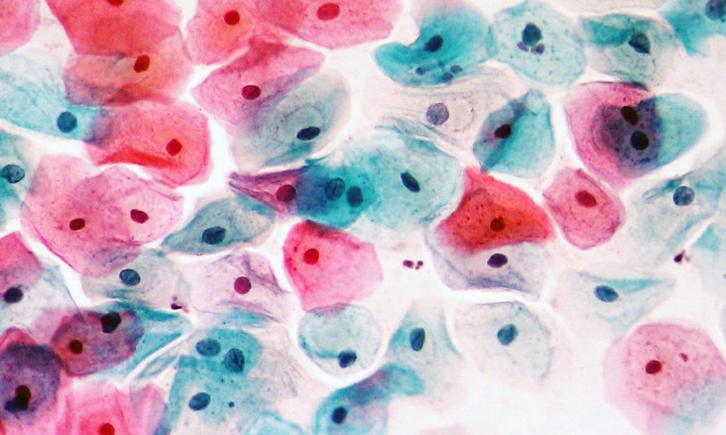 citología vaginal en virus del papiloma humano